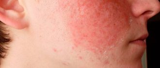 Allergy on the cheeks
