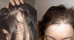 Гормональное выпадение волос у подростков