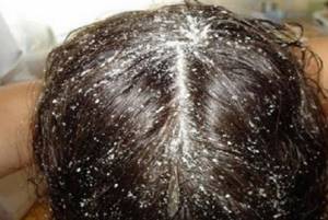 Солевой пилинг волос