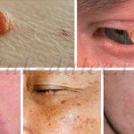 Заболевания кожи лица